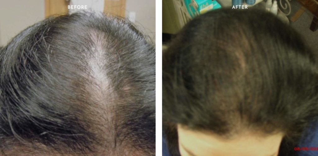 Low Level Laser Hair Loss Therapy Hair Loss Therapy Of North Dakota